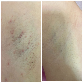 До ЛЕ та після першого сеансу ЛЕ