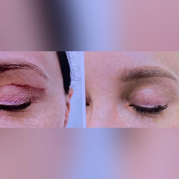 Полінуклеотид REJURAN
                    Косметологічний центр МаКо Київ