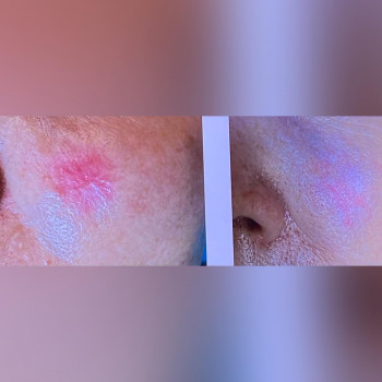 Полінуклеотид REJURAN
                    Косметологічний центр МаКо Київ