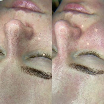 Комбінована чистка обличчя