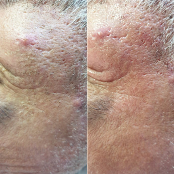 Комбінована чистка обличчя