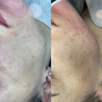 Комбінована чистка обличчя (комплексна)
                    Косметологічний центр O.L.Beauty Київ