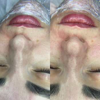 Комбінована чистка обличчя