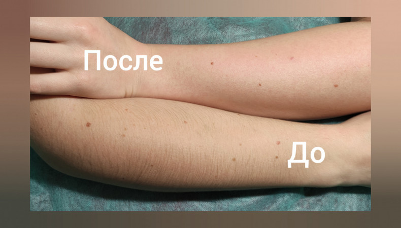 Шугаринг рук до ліктя, фото - Мастер депиляции Яна Дукачова