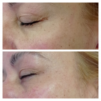 Фракціний rfліфтинг до та одразу після процедури   