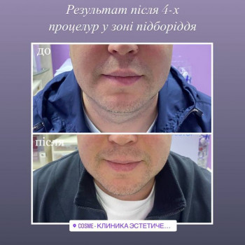 корекція фігури, корекціяз моршок