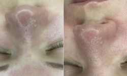 Ультразвукова чистка обличчя з доглядом Косметологический центр O.L.Beauty Киев