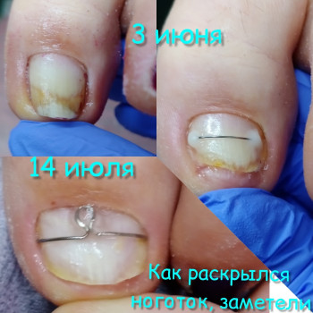 Коррекционная сиситема - "Титановая нить"