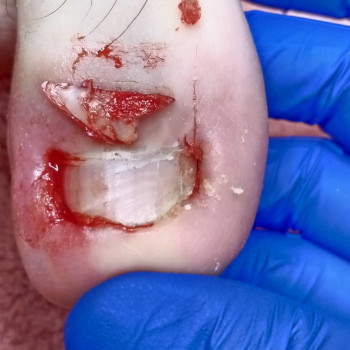 Удаление вросшей части ногтя без боли.