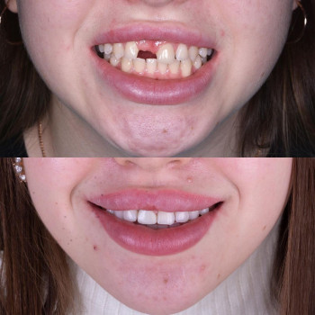 Імплантація, фото - стоматолог Вепа Джумаев