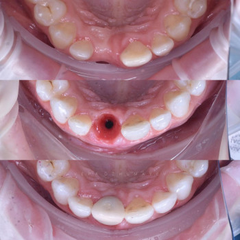 Імплантація, фото - стоматолог Вепа Джумаев