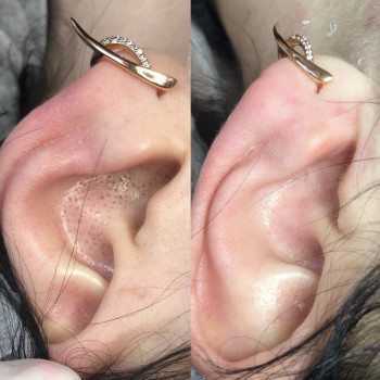 Механічна чистка