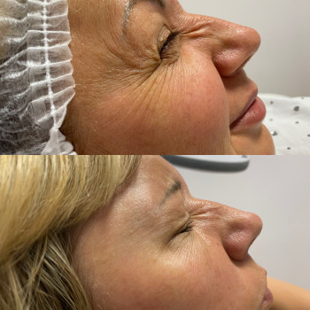 Ботулінотерапія( гусячі лапки)