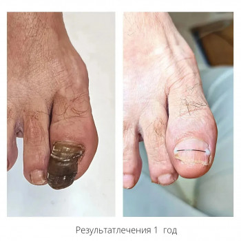 лечение стопы