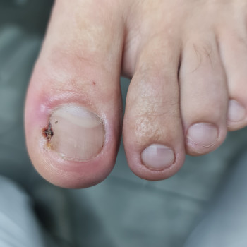 Лечение вросших ногтей
                    Центры подологии PodoPlex Одесса