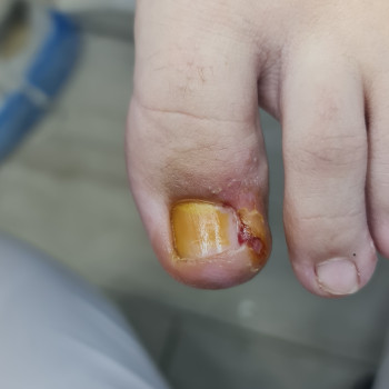 Лечение вросших ногтей
                    Центры подологии PodoPlex Одесса