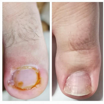 Лечение вросших ногтей
                    Центры подологии PodoPlex Одесса