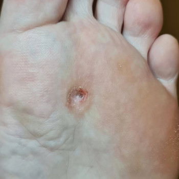 Удаление стержневой мозоли Одесса
                    Центры подологии PodoPlex Одесса