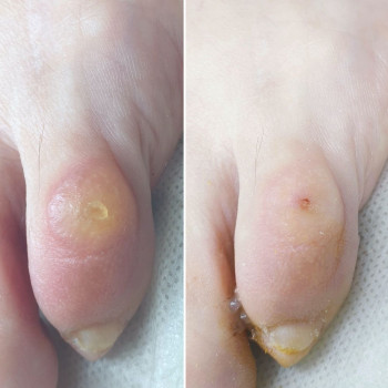 Удаление стержневой мозоли Одесса
                    Центры подологии PodoPlex Одесса