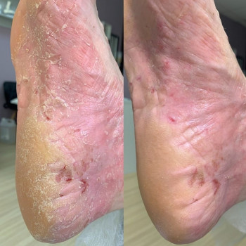 Удаление трещин на стопе Одесса
                    Центры подологии PodoPlex Одесса