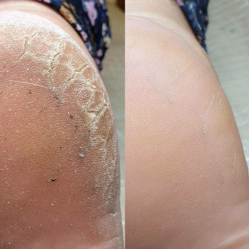 Удаление трещин на стопе Одесса
                    Центры подологии PodoPlex Одесса