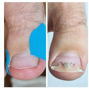 Установка корректирующей системы 3то
                    Центры подологии PodoPlex Одесса