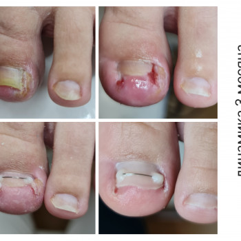 Титановая нить коррекция вросшего ногтя
                    Центры подологии PodoPlex Одесса