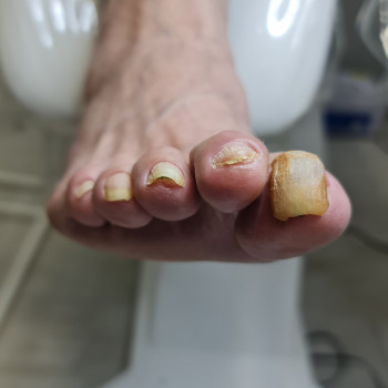 Удаление онихогрифоза
                    Центры подологии PodoPlex Одесса