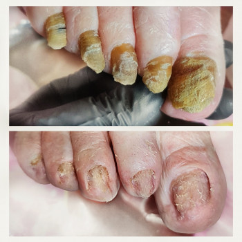 Удаление онихогрифоза
                    Центры подологии PodoPlex Одесса