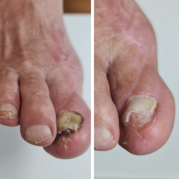 Удаление онихогрифоза
                    Центры подологии PodoPlex Одесса