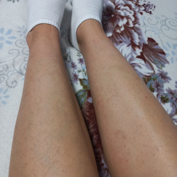 Электроэпиляция Одесса
                    Майстер депіляції Галина Одеса