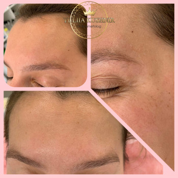 Botox Allergan для зони лоба
                    Лікар-косметолог Юлія Луцьк