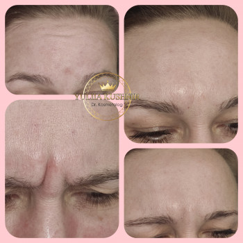 Botox Allergan для зони лоба
                    Лікар-косметолог Юлія Луцьк