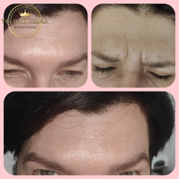Botox Allergan для зони лоба
                    Лікар-косметолог Юлія Луцьк