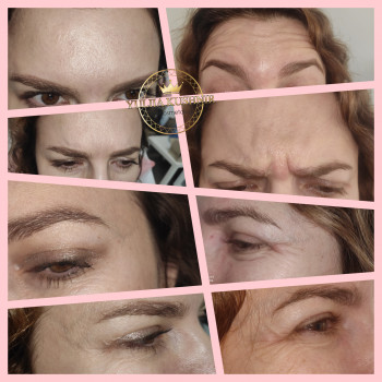 Botox Allergan для зони лоба
                    Лікар-косметолог Юлія Луцьк