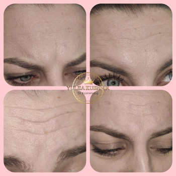 Botox Allergan для зони лоба
                    Лікар-косметолог Юлія Луцьк