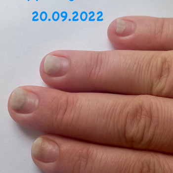 Хімічний опік , оніхолізис