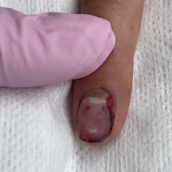 Лікування нігтя після удару