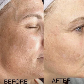 Біоревіталізація
                    Косметолог Лілія Ровно