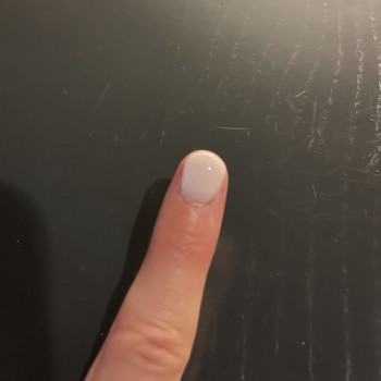 Так виглядає травмований ніготь після протезування