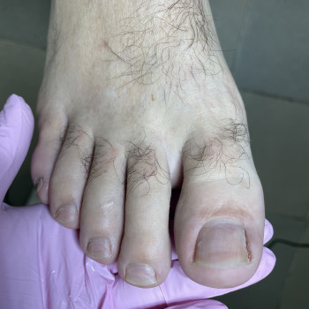 До видалення врослого нігтя 1 стадіі