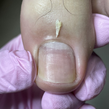 Після видалення врослого нігтя 1 стадіі