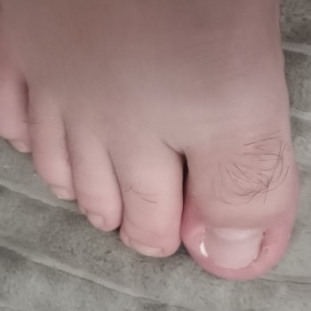 Після видалення врослого нігтя 2 стадіі, та встановлення там