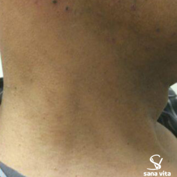 видалення новоутворень радіохвильовим методом