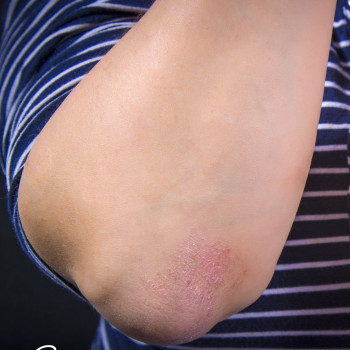 ефект від біотерапії псоріазу (проміжний) на 3 тиждень