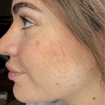 Результат лікування акне