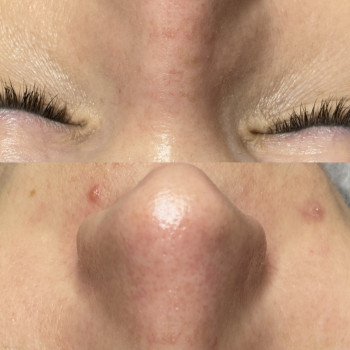 Комбінована чистка
   