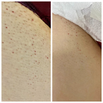 бедро до та після першої процедури ЛЕ