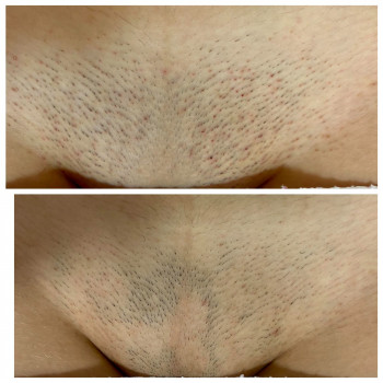 бікіні до та після першої процедури ЛЕ