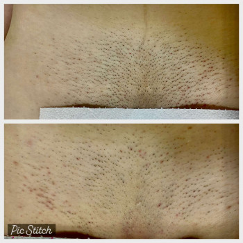 бікіні до та після першої процедури ЛЕ